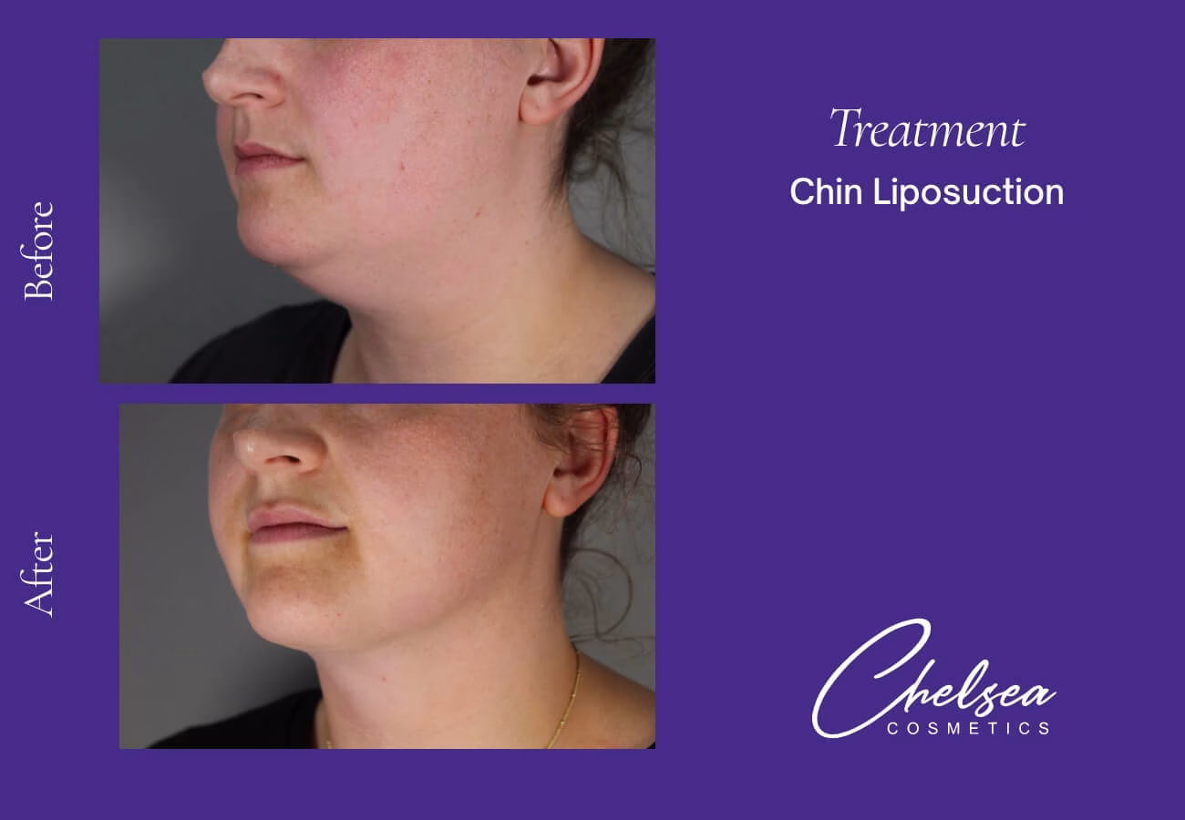 Liposuction — Chelsea Cosmetics Melbourne