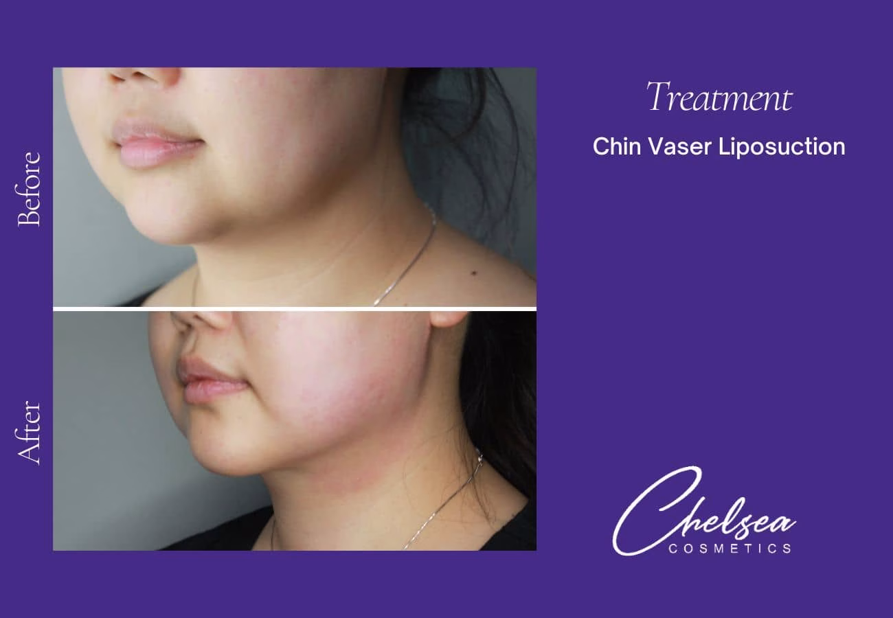 Liposuction — Chelsea Cosmetics Melbourne