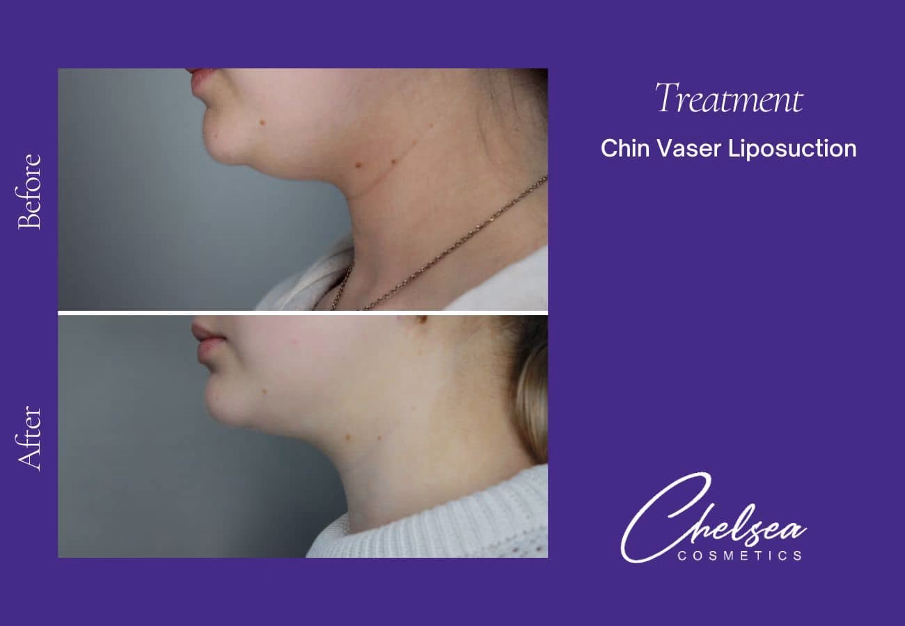 Liposuction — Chelsea Cosmetics Melbourne