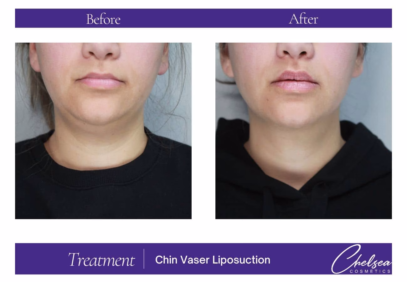 Liposuction — Chelsea Cosmetics Melbourne