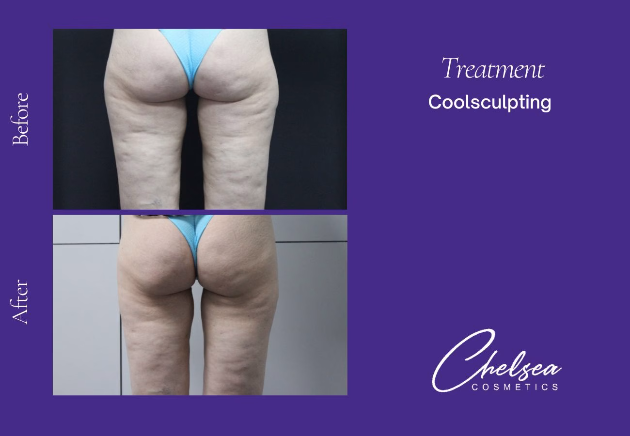 CoolSculpting — Chelsea Cosmetics Melbourne