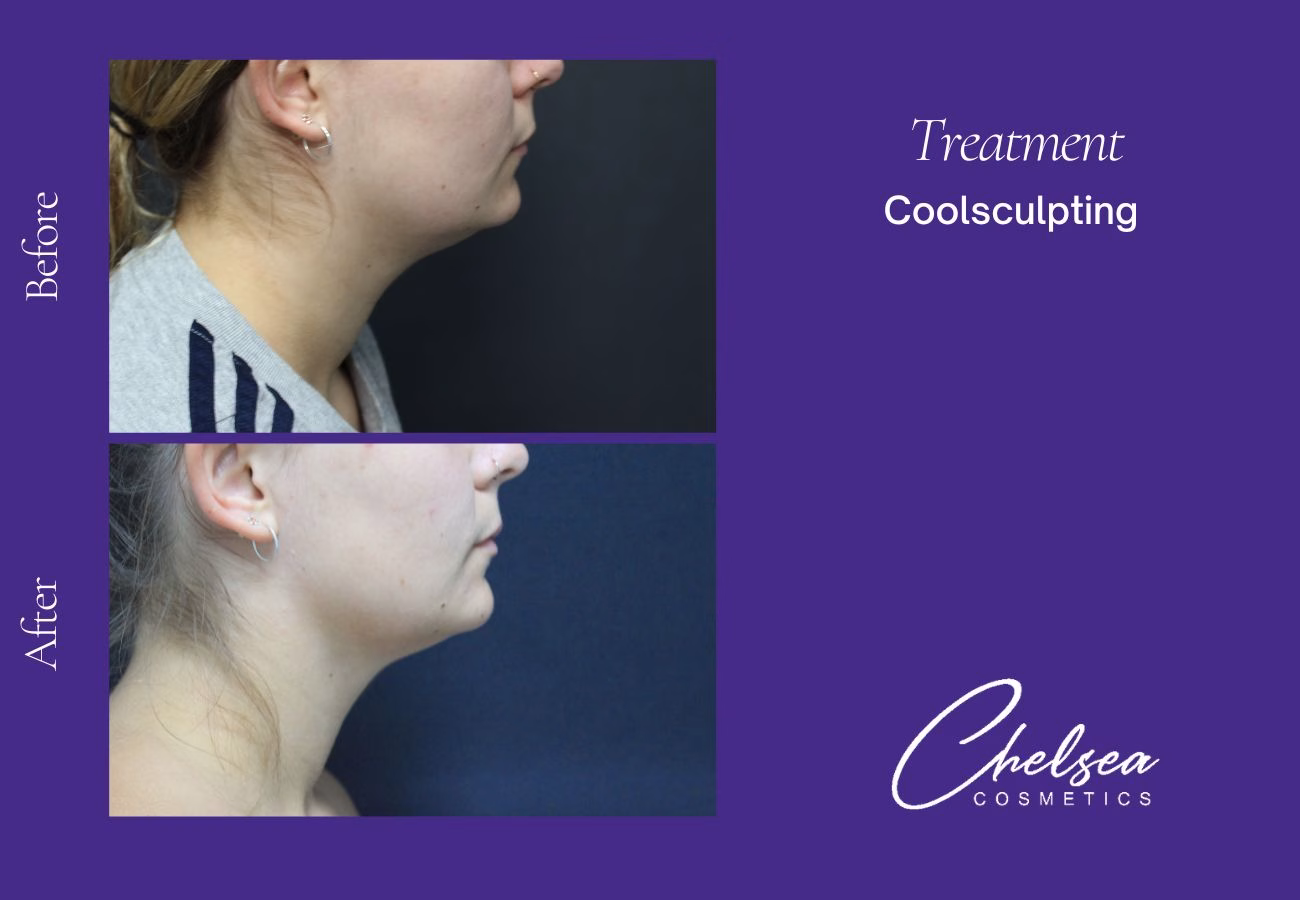 CoolSculpting — Chelsea Cosmetics Melbourne