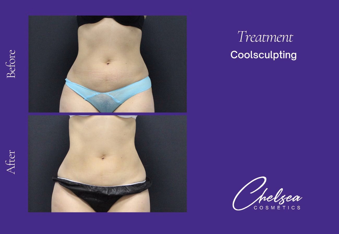 CoolSculpting — Chelsea Cosmetics Melbourne