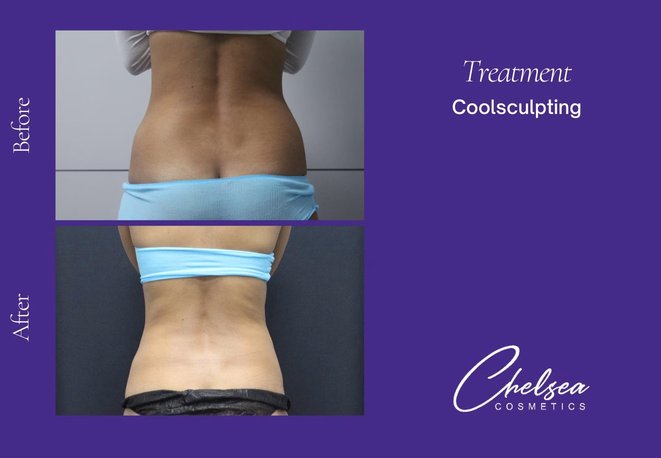 CoolSculpting — Chelsea Cosmetics Melbourne
