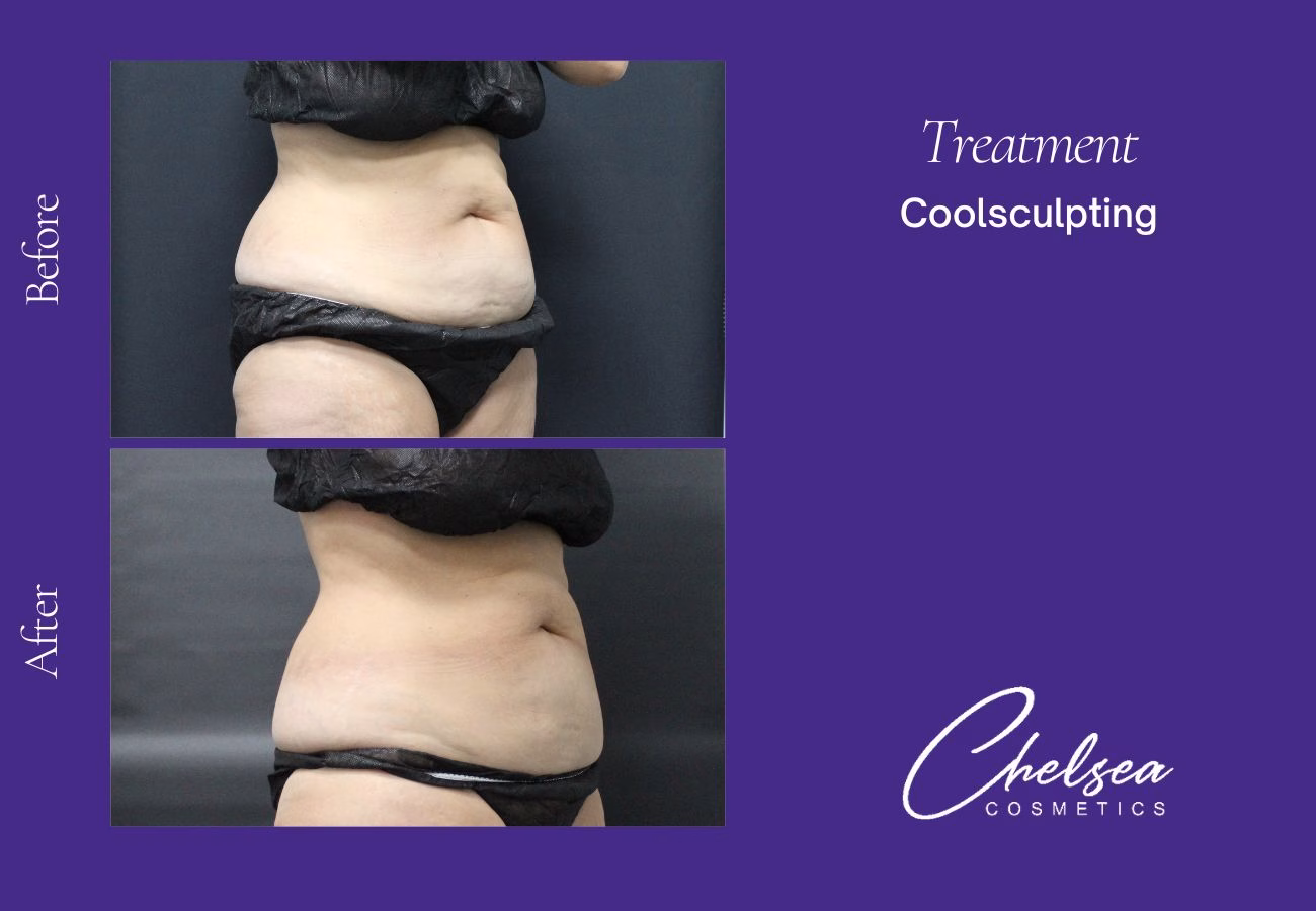 CoolSculpting — Chelsea Cosmetics Melbourne