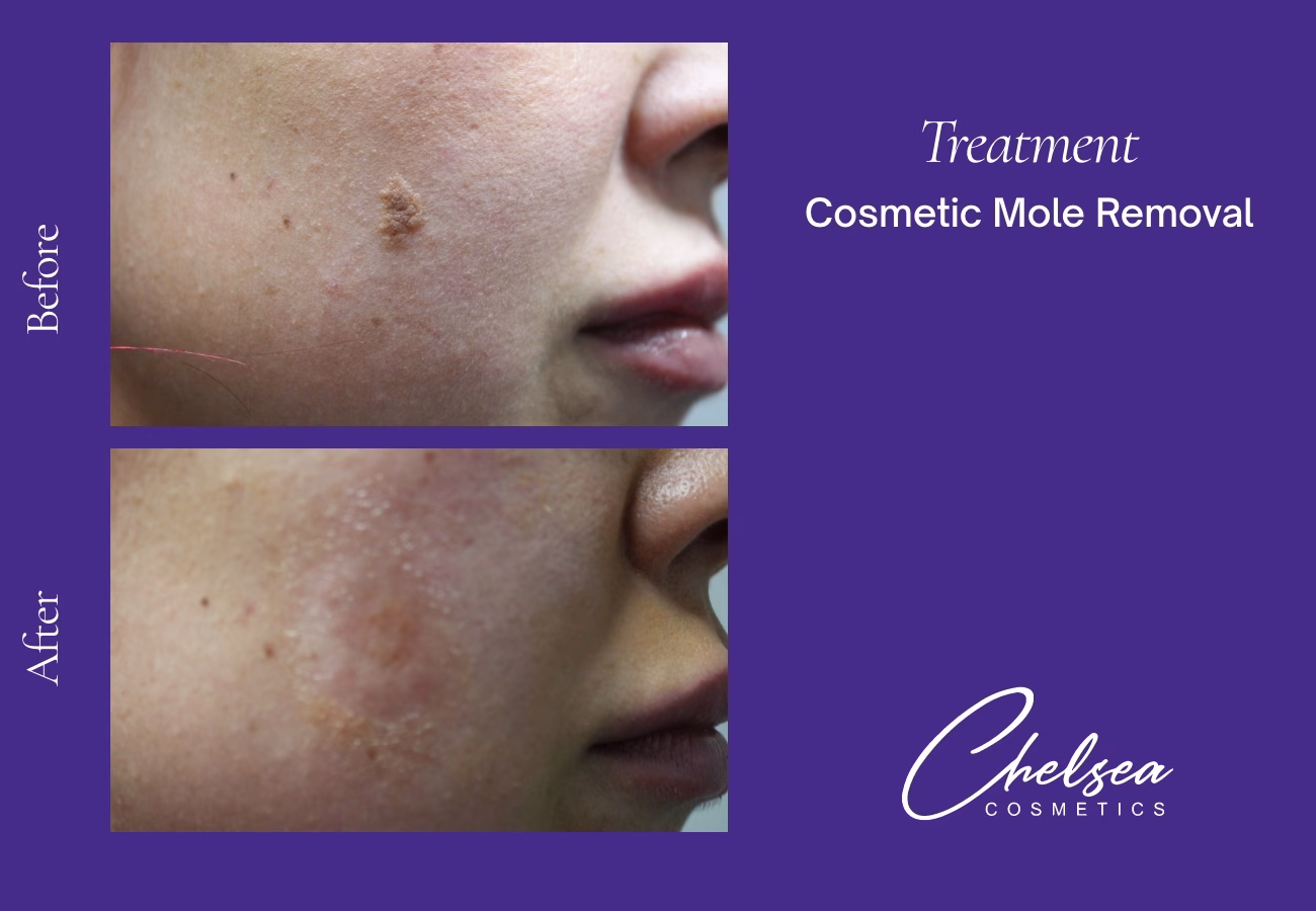 Cosmetic Mole Removal — Chelsea Cosmetics Melbourne
