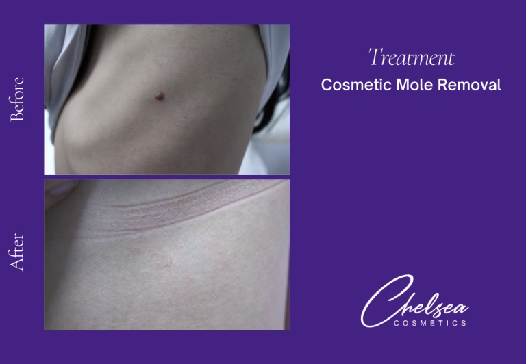 Cosmetic Mole Removal — Chelsea Cosmetics Melbourne