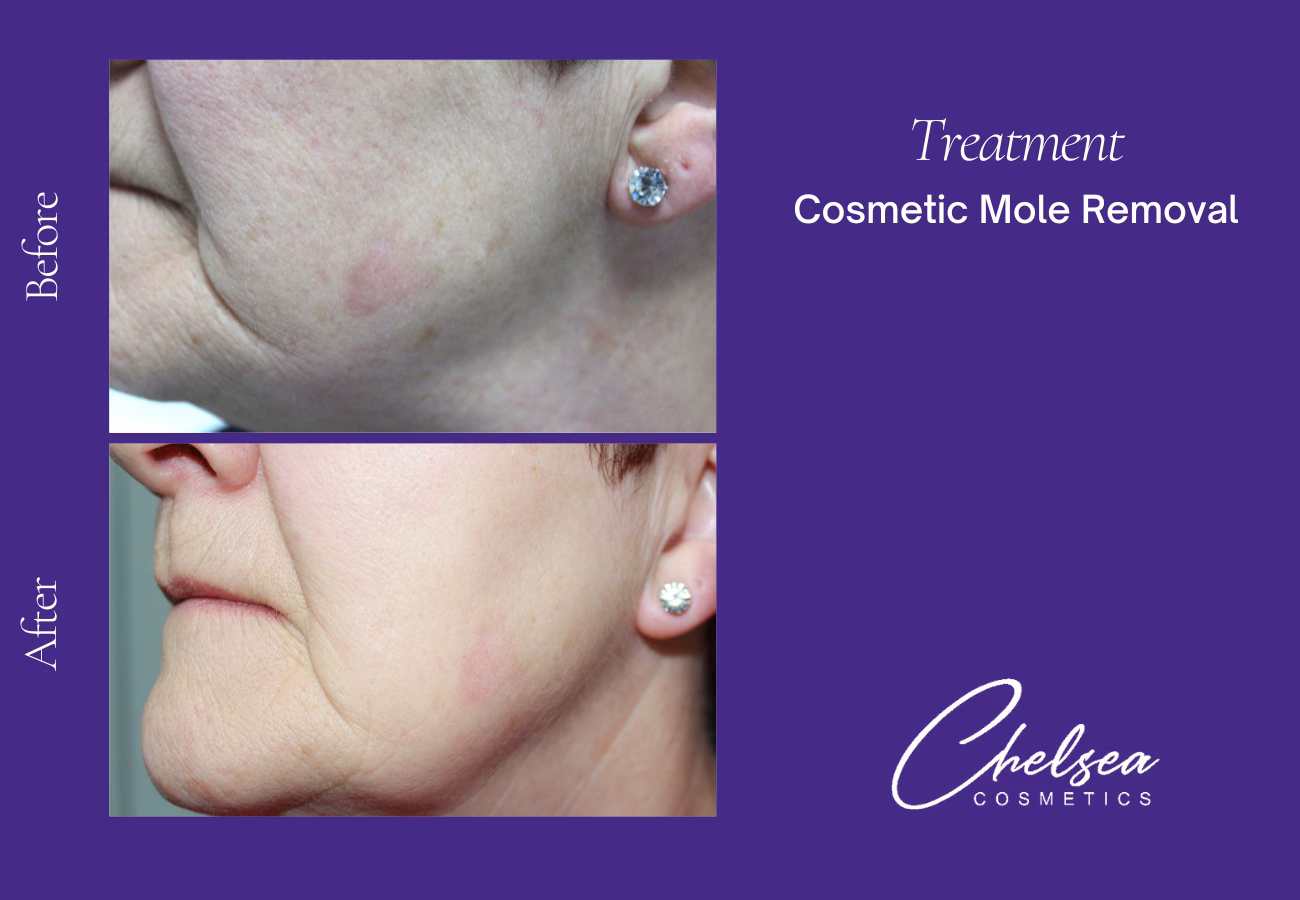 Cosmetic Mole Removal — Chelsea Cosmetics Melbourne