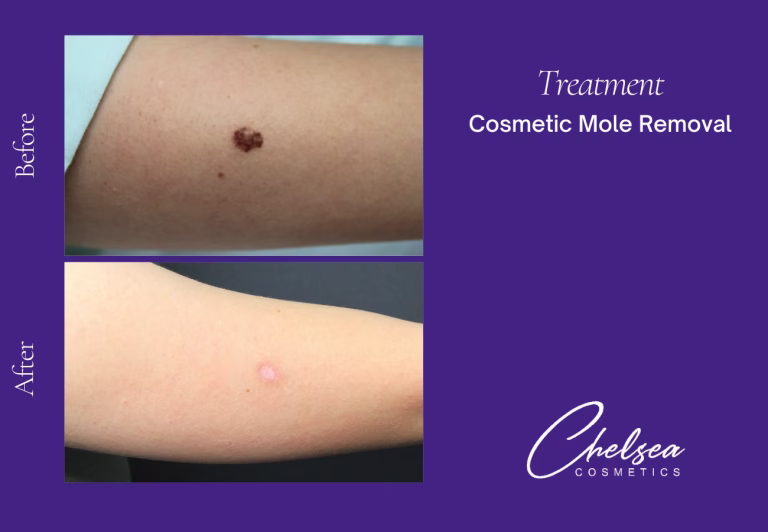 Cosmetic Mole Removal — Chelsea Cosmetics Melbourne