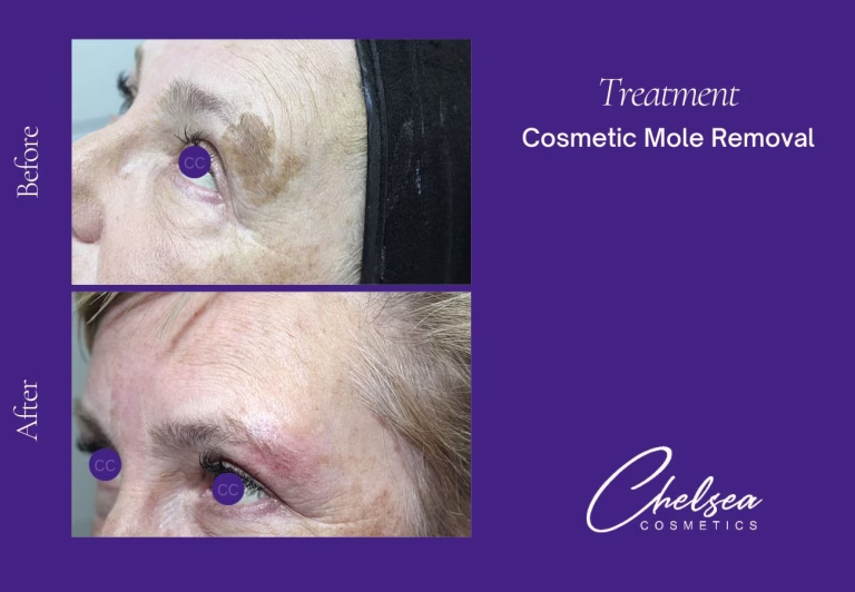 Cosmetic Mole Removal — Chelsea Cosmetics Melbourne