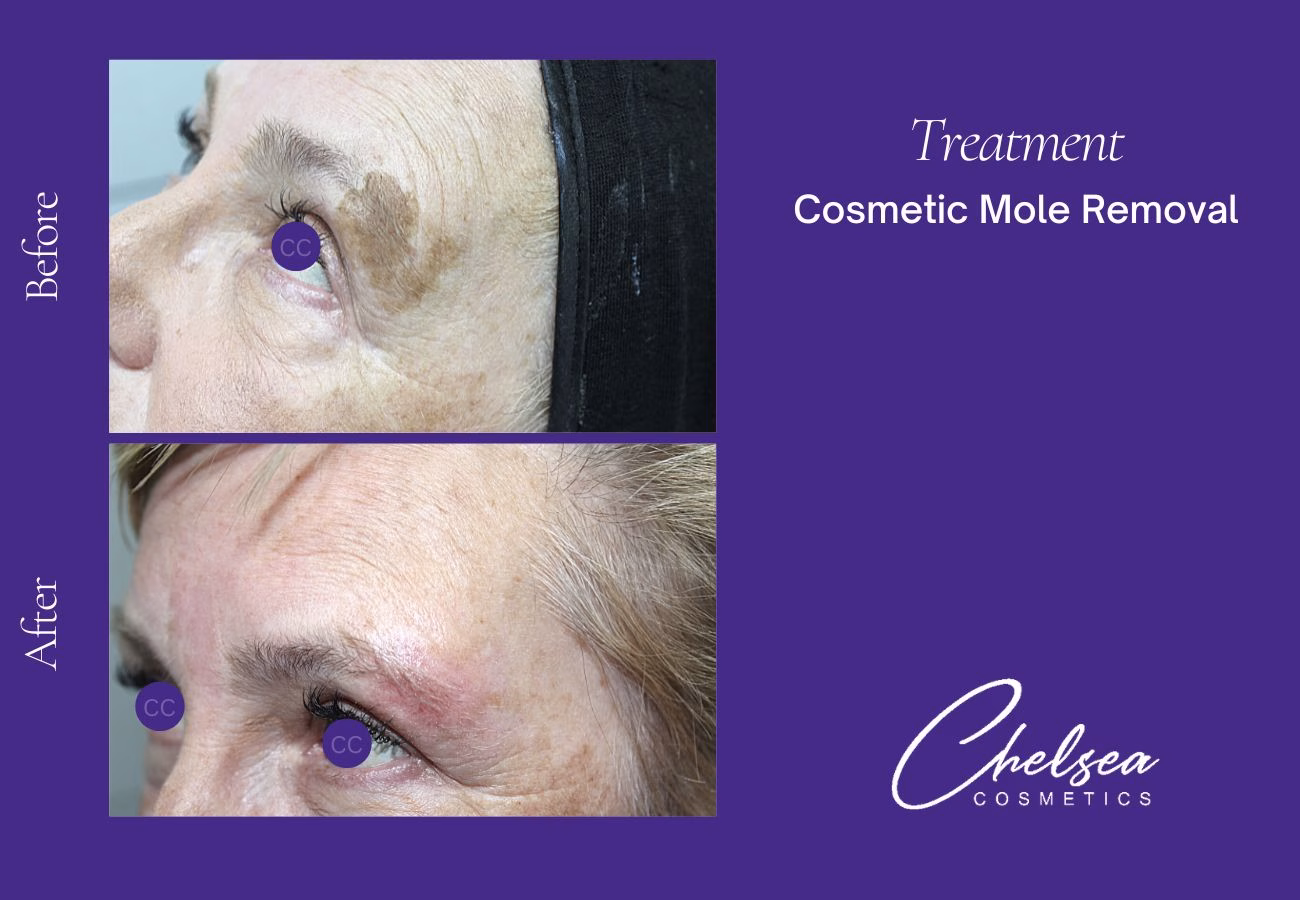 Cosmetic Mole Removal — Chelsea Cosmetics Melbourne