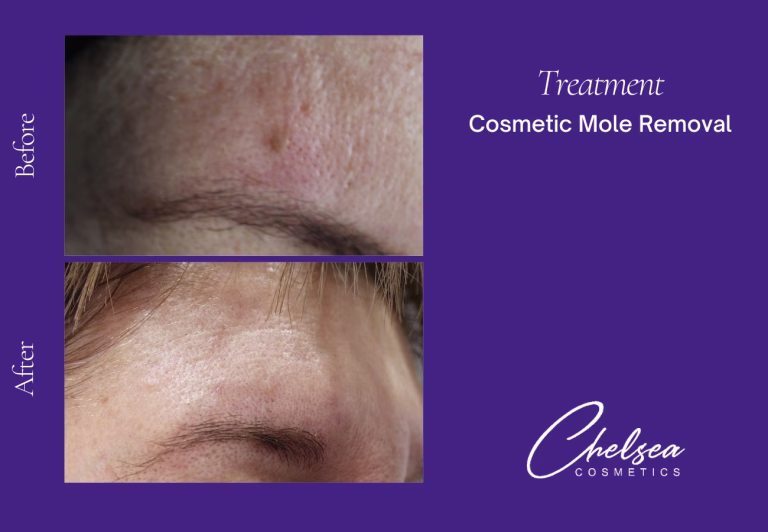 Cosmetic Mole Removal — Chelsea Cosmetics Melbourne