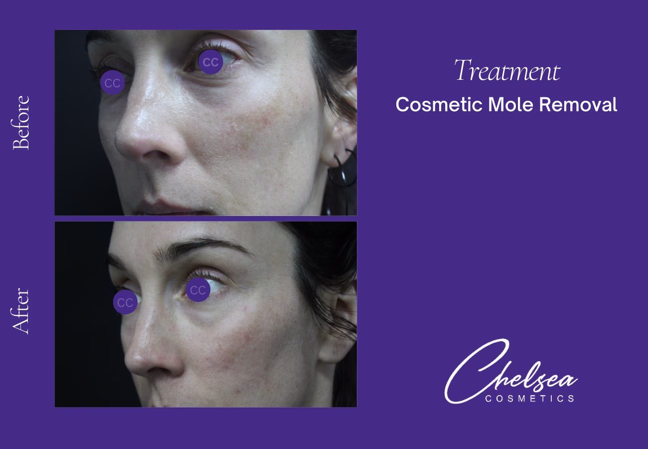 Cosmetic Mole Removal — Chelsea Cosmetics Melbourne