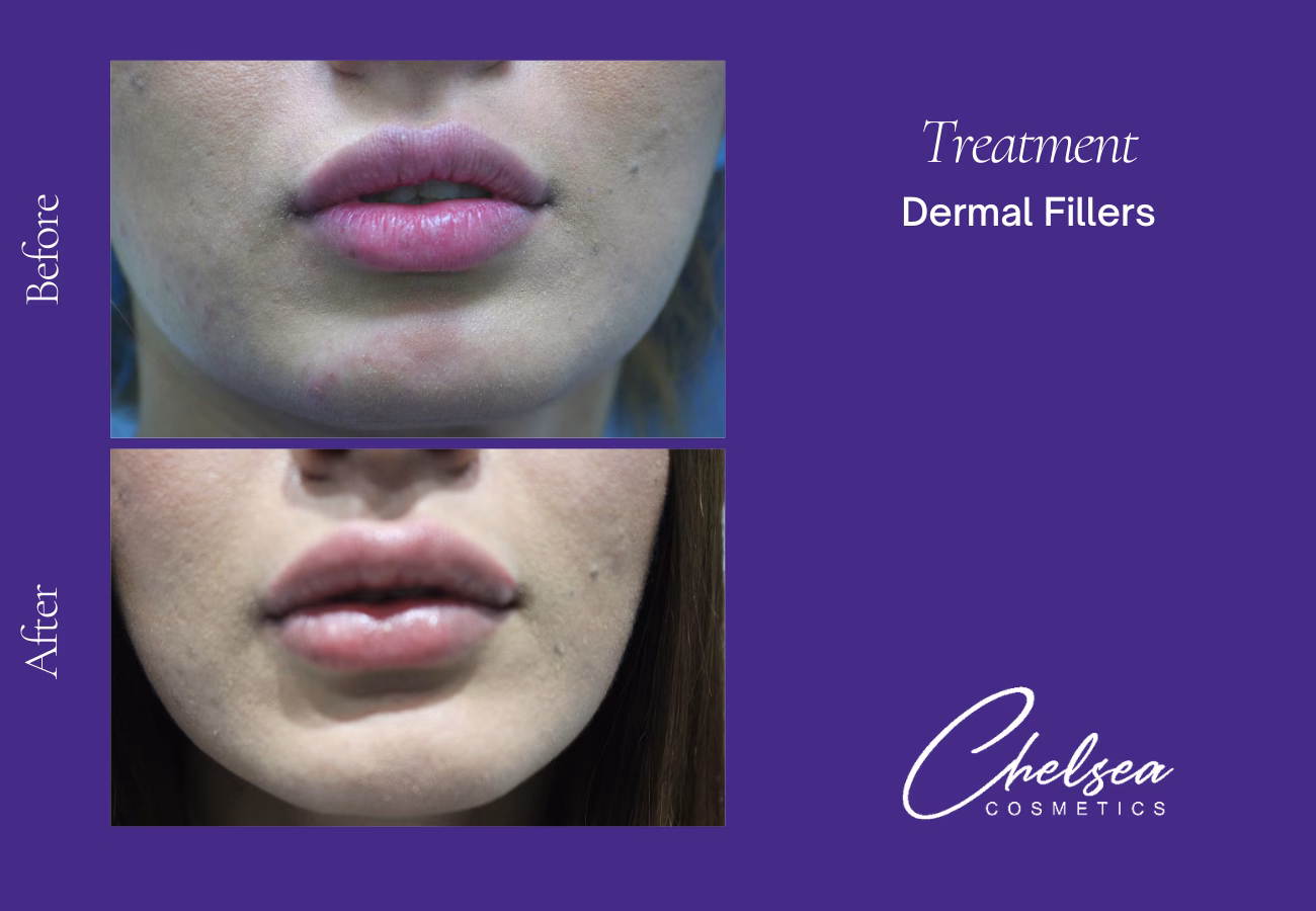 Dermal fillers — Chelsea Cosmetics Melbourne