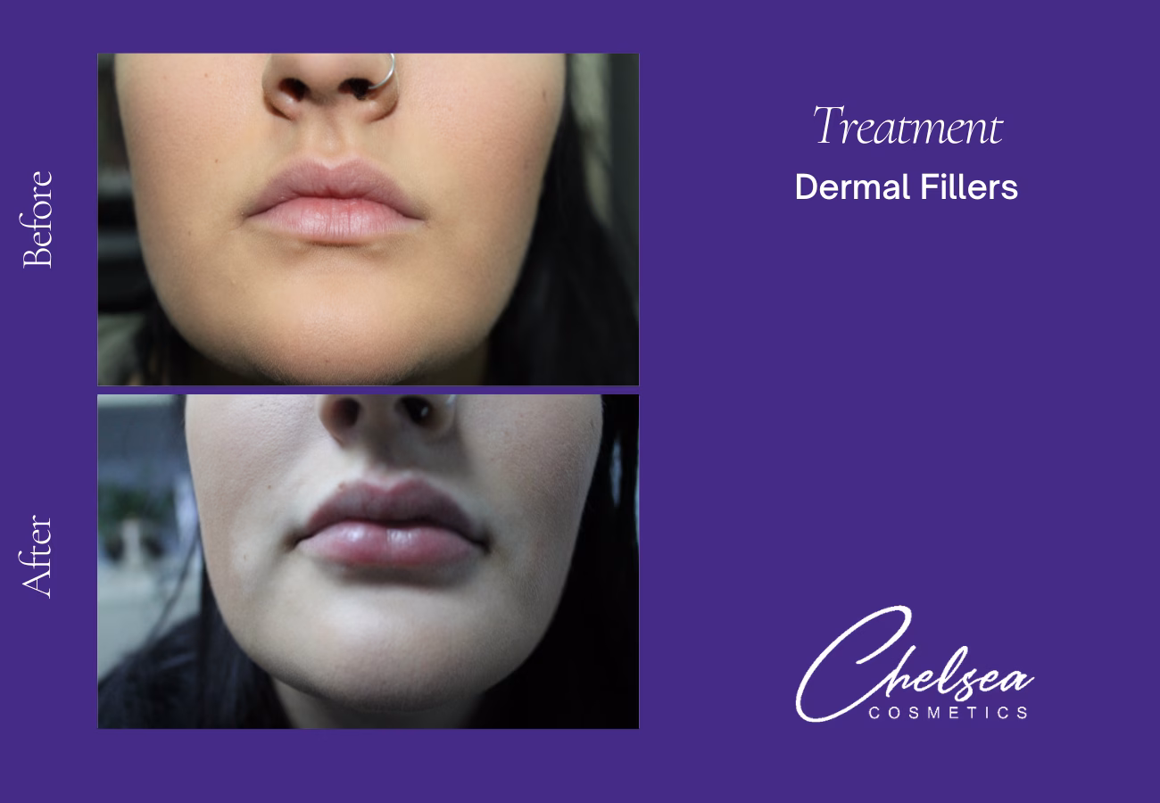 Dermal fillers — Chelsea Cosmetics Melbourne