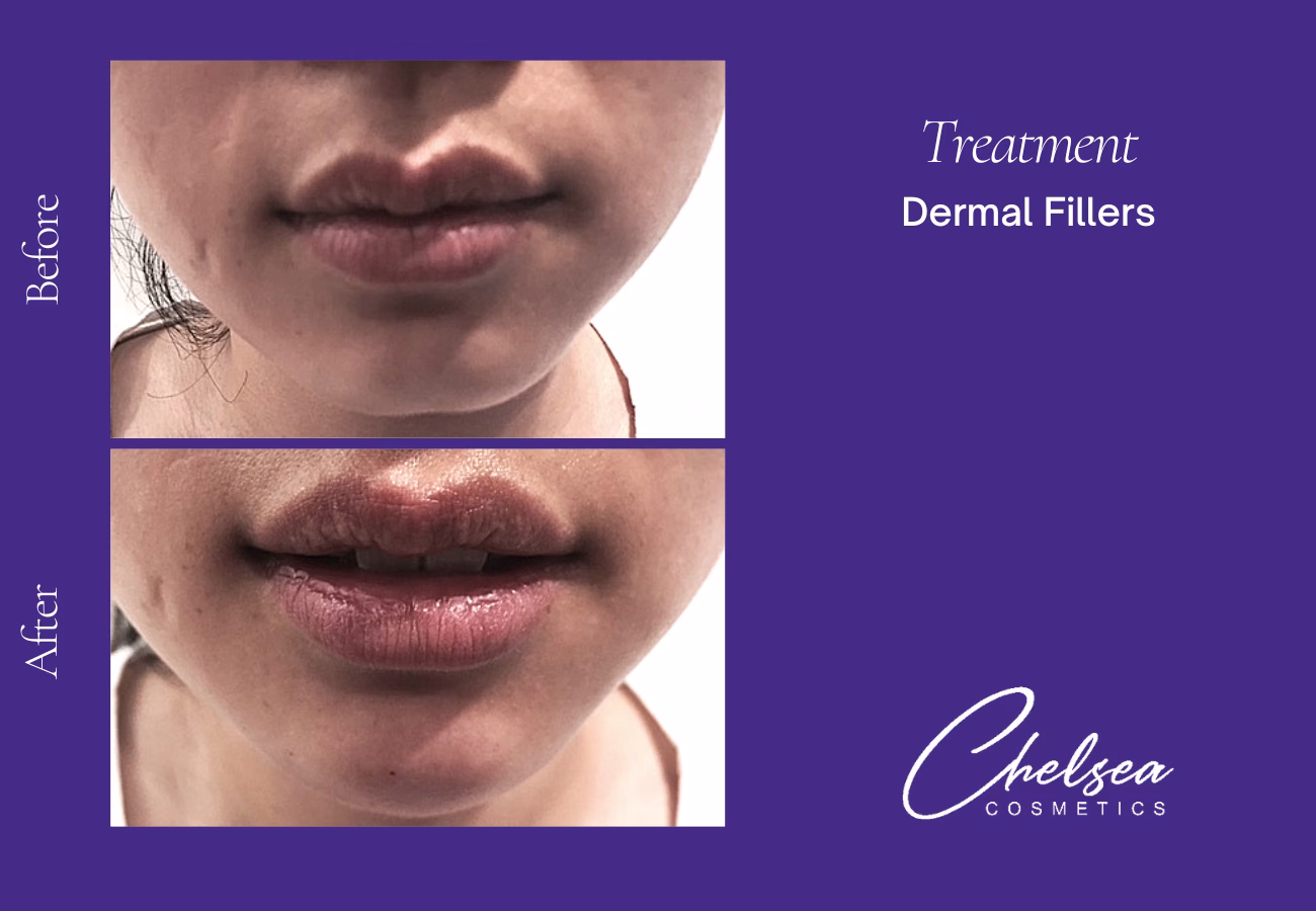 Dermal fillers — Chelsea Cosmetics Melbourne