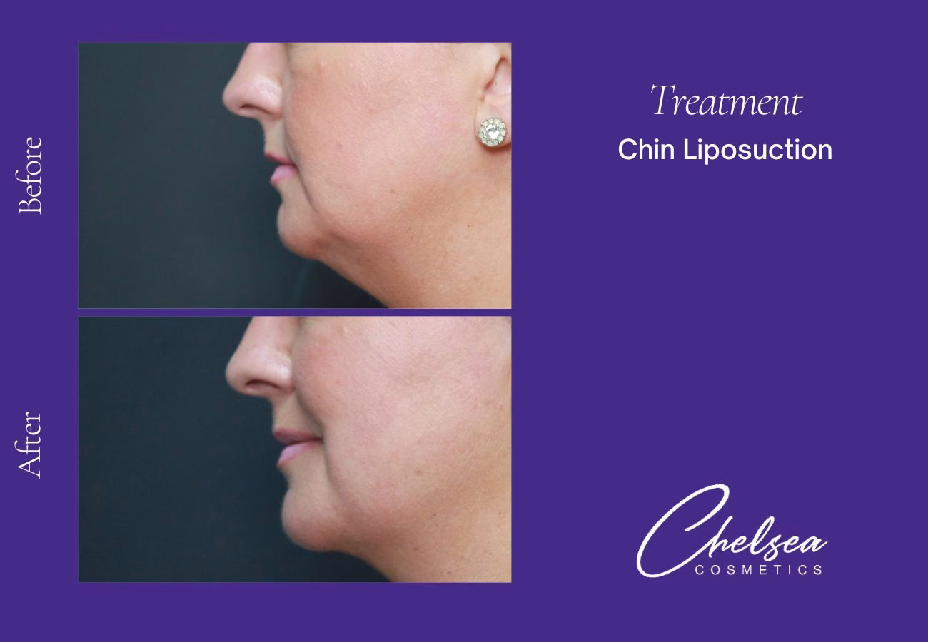 Liposuction — Chelsea Cosmetics Melbourne