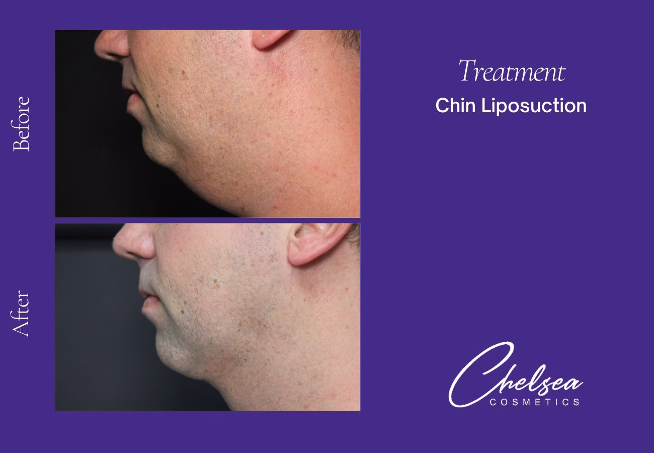 Liposuction — Chelsea Cosmetics Melbourne