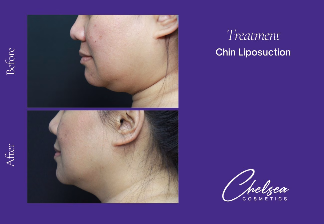 Liposuction — Chelsea Cosmetics Melbourne