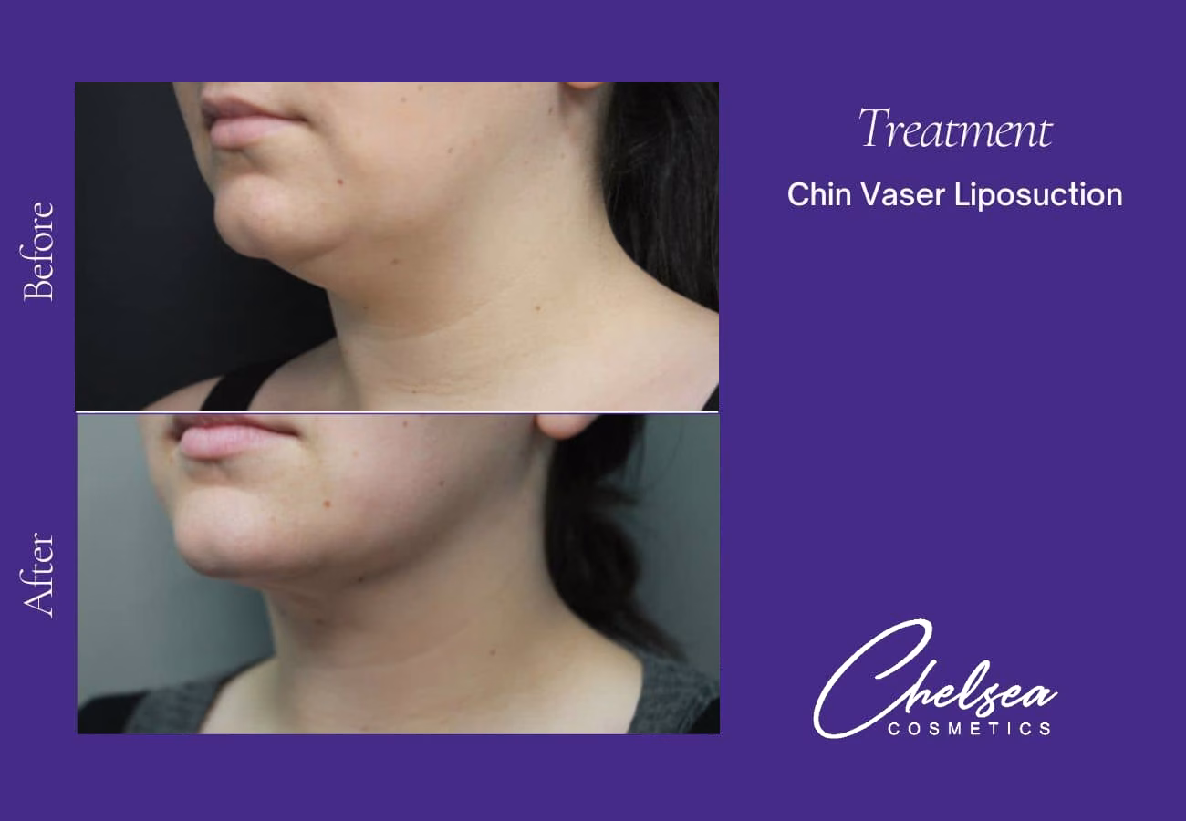 Liposuction — Chelsea Cosmetics Melbourne