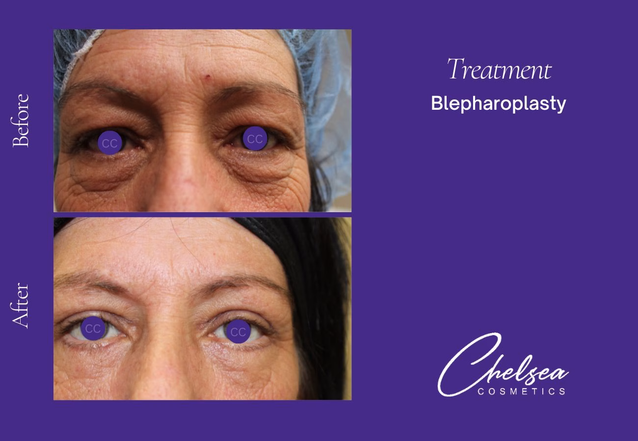 Breast Augmentation — Chelsea Cosmetics Melbourne