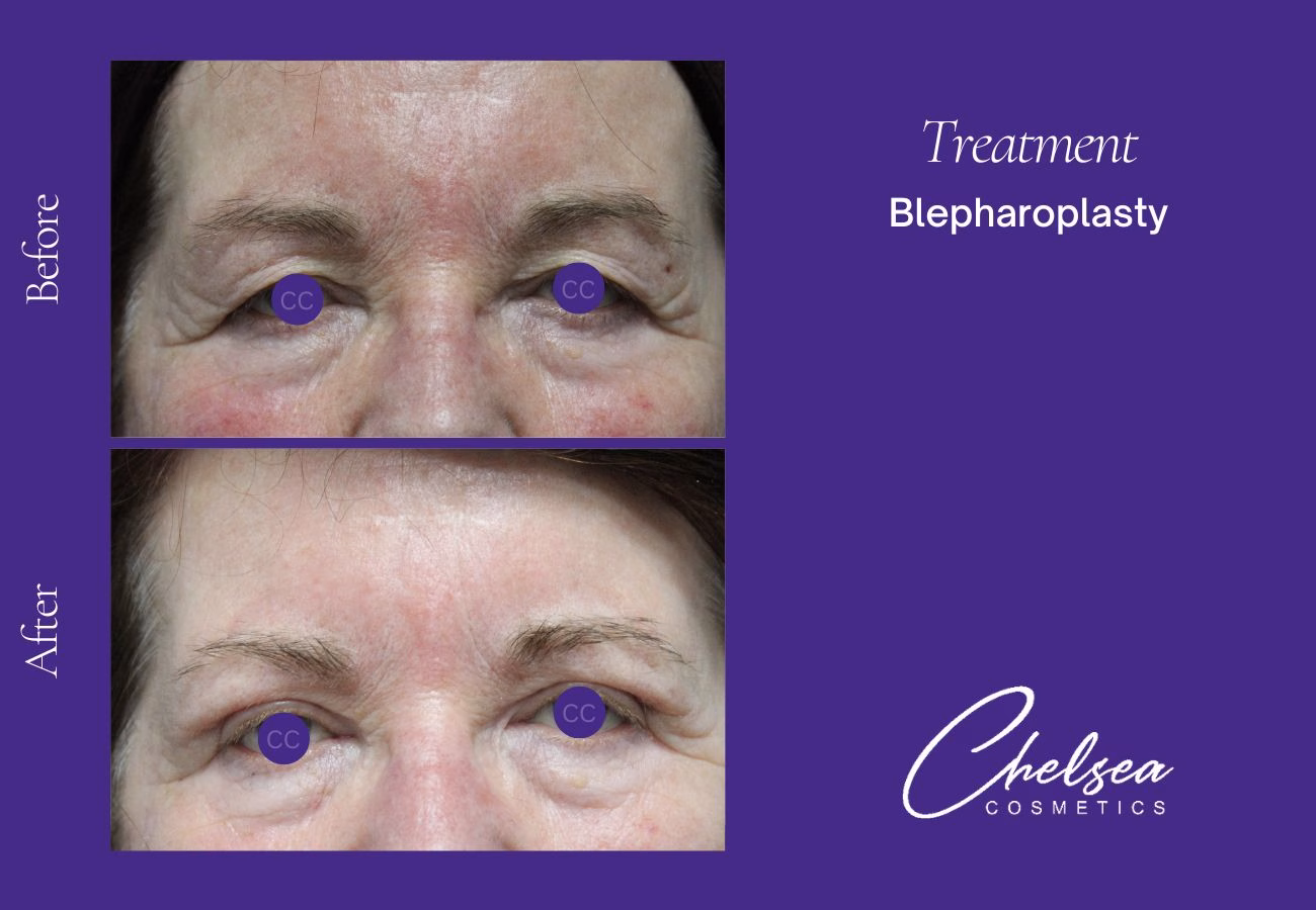 Breast Augmentation — Chelsea Cosmetics Melbourne