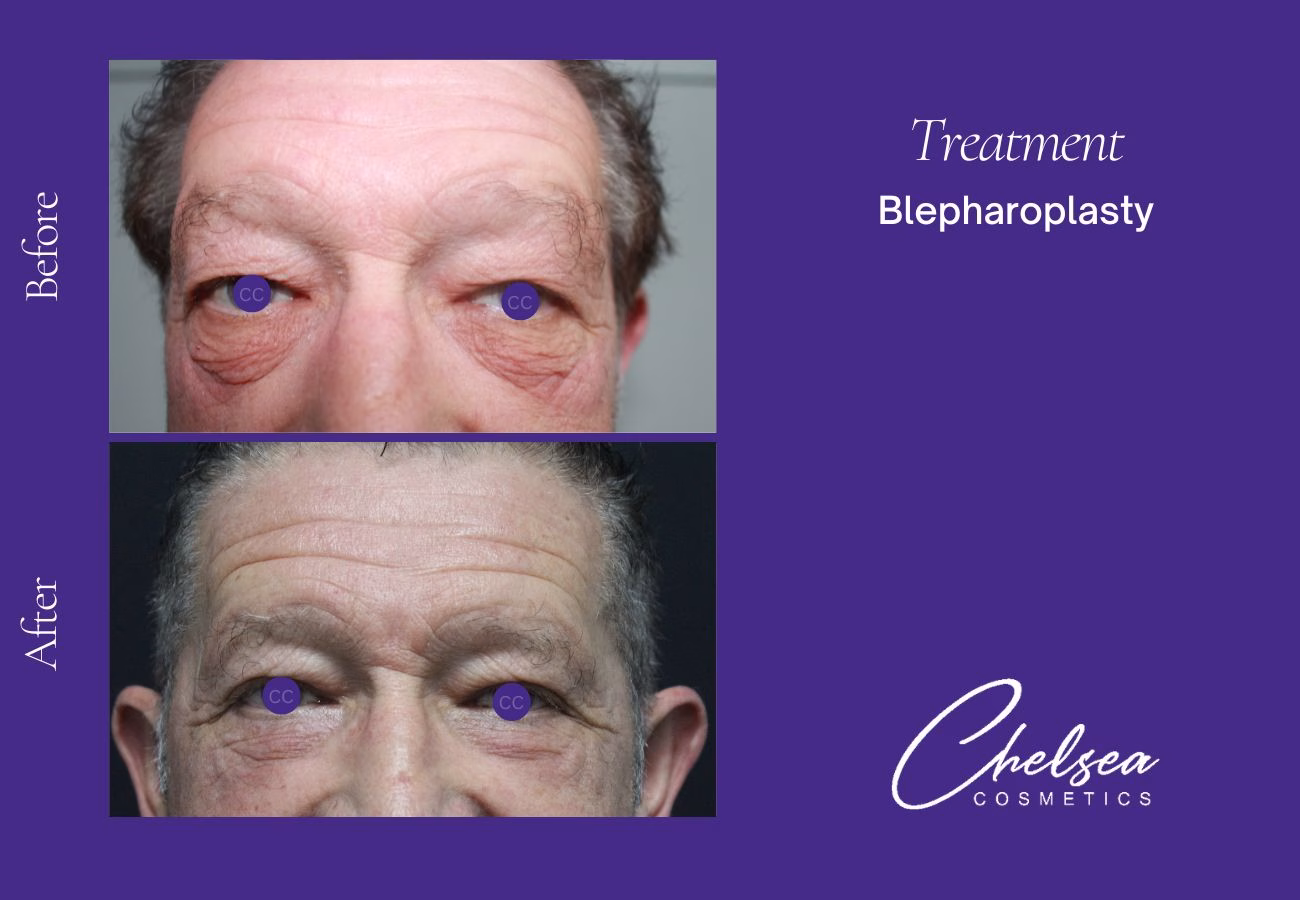 Breast Augmentation — Chelsea Cosmetics Melbourne