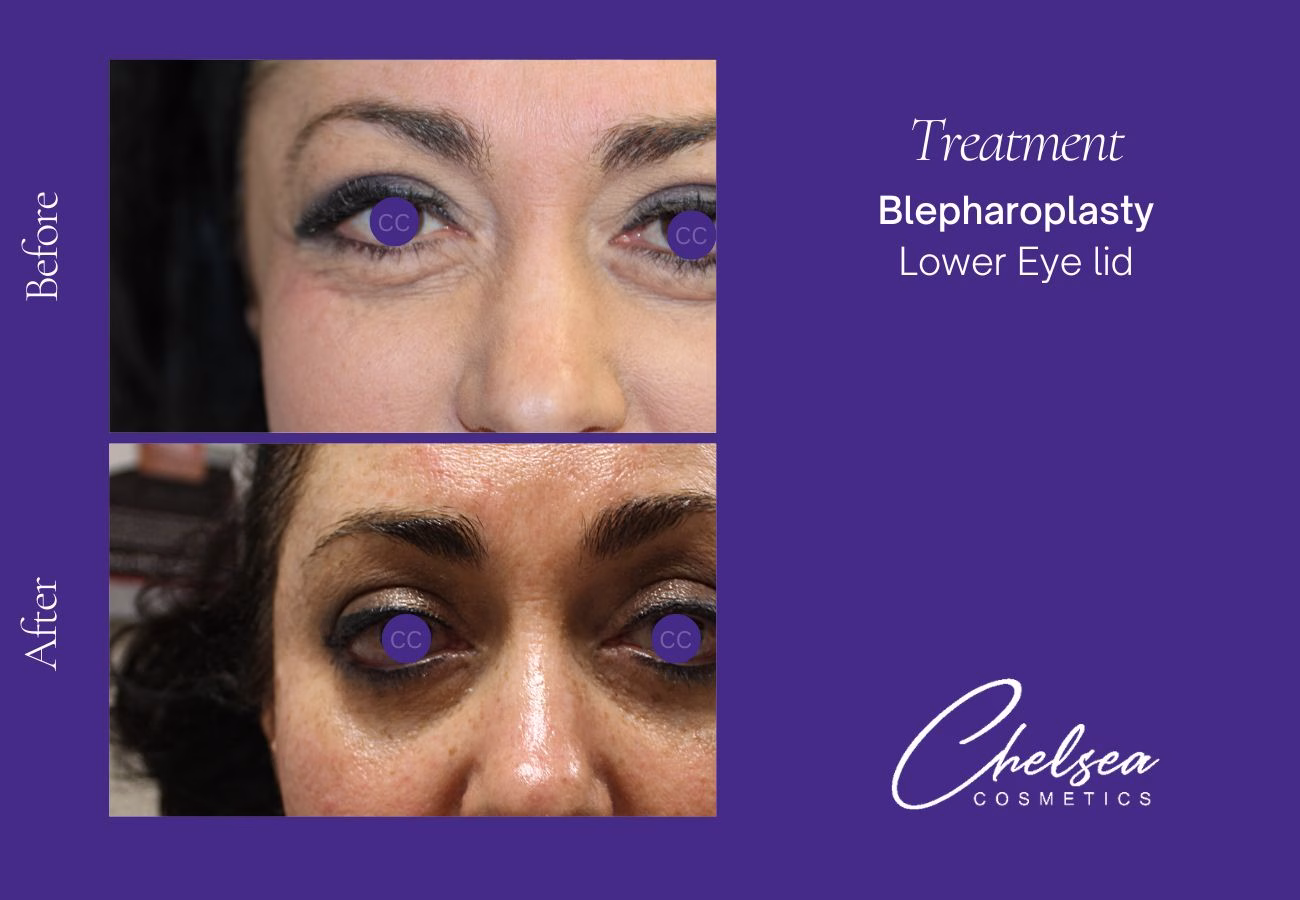 Breast Augmentation — Chelsea Cosmetics Melbourne