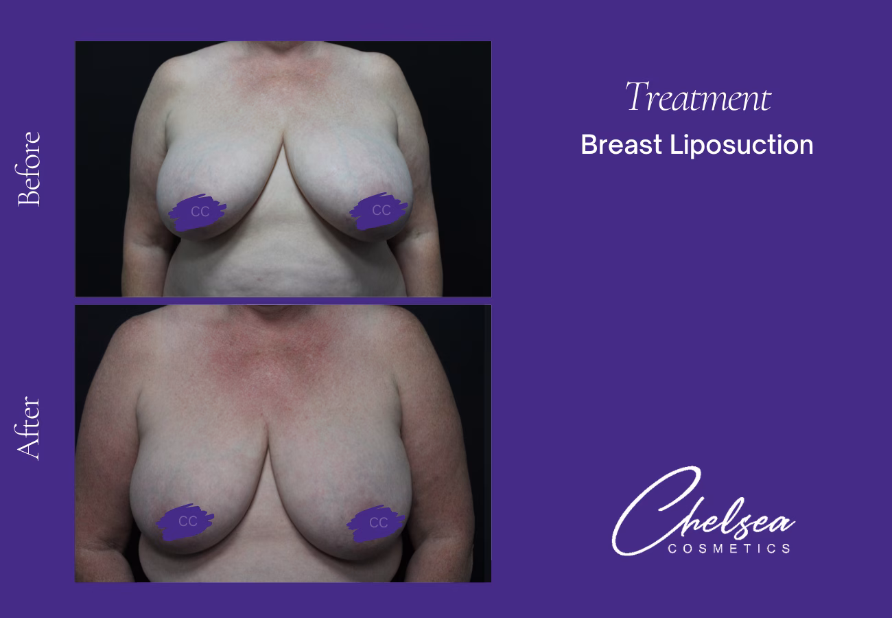 Breast Augmentation — Chelsea Cosmetics Melbourne