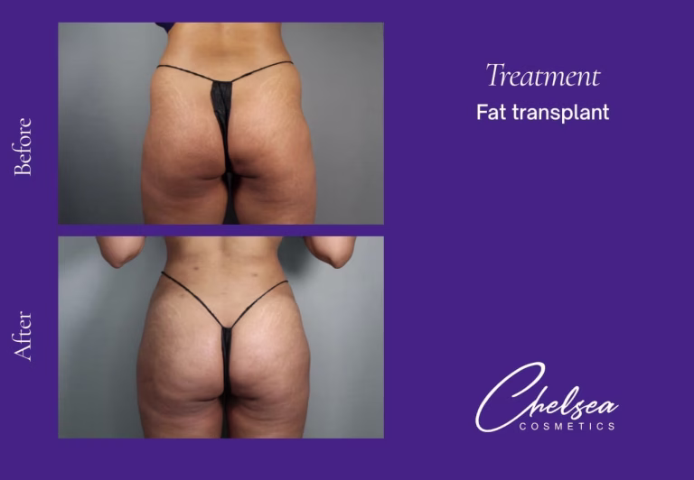 Fat Transfer to Buttock