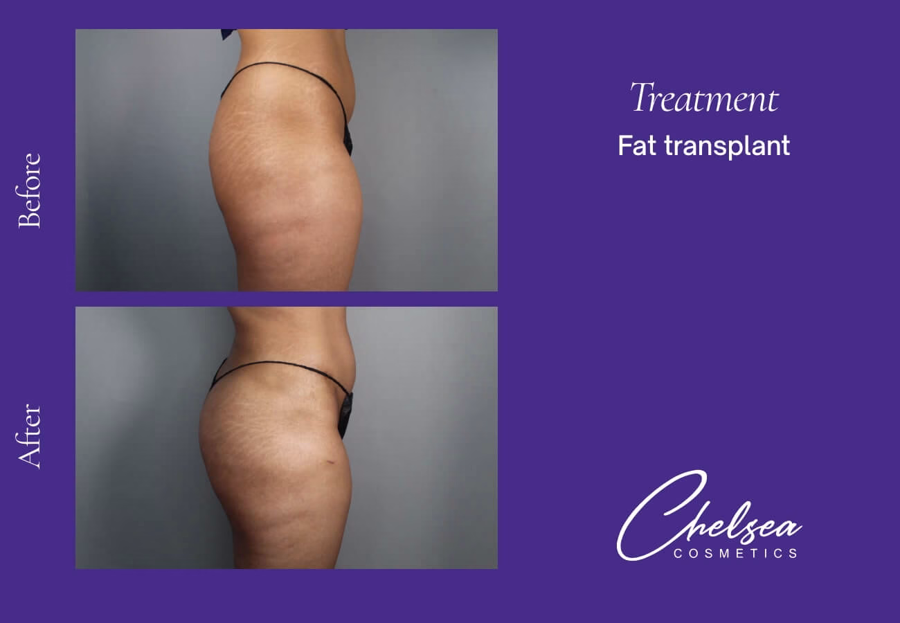 Fat-Transplant-1-2 — Chelsea Cosmetics Melbourne