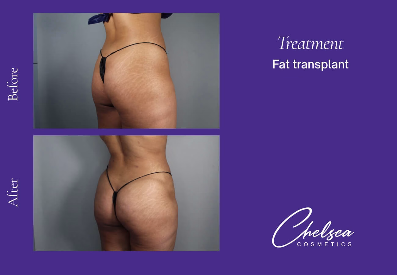 Fat-Transplant-1-3 — Chelsea Cosmetics Melbourne