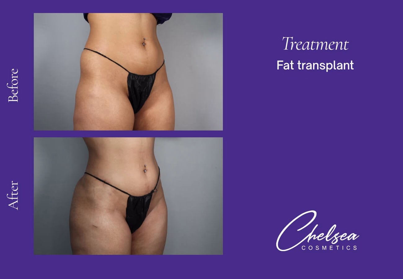 Fat-Transplant-1-4 — Chelsea Cosmetics Melbourne