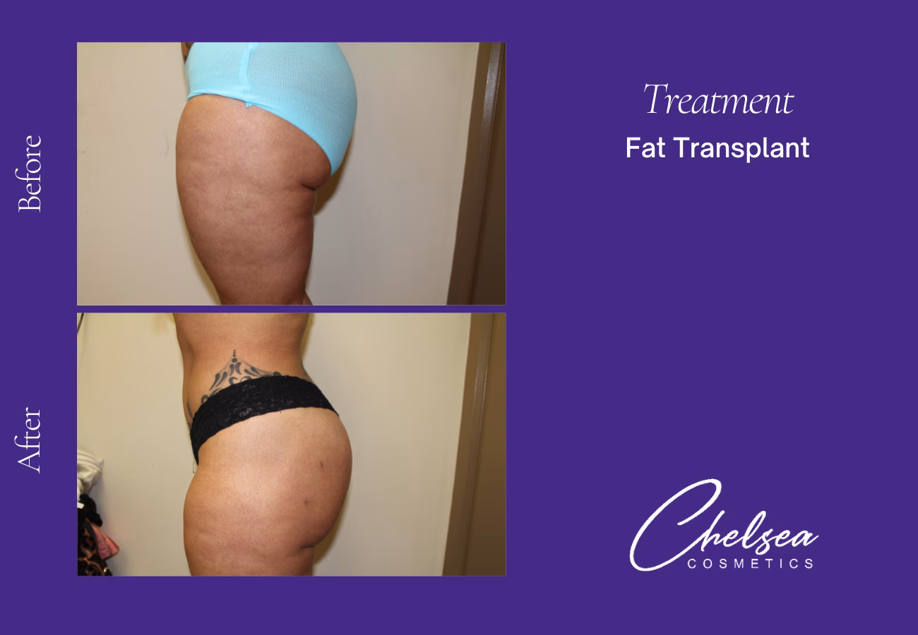 Fat transplant — Chelsea Cosmetics Melbourne