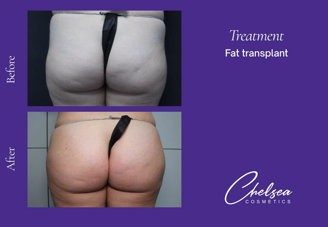 Fat-Transplant-2-1 — Chelsea Cosmetics Melbourne