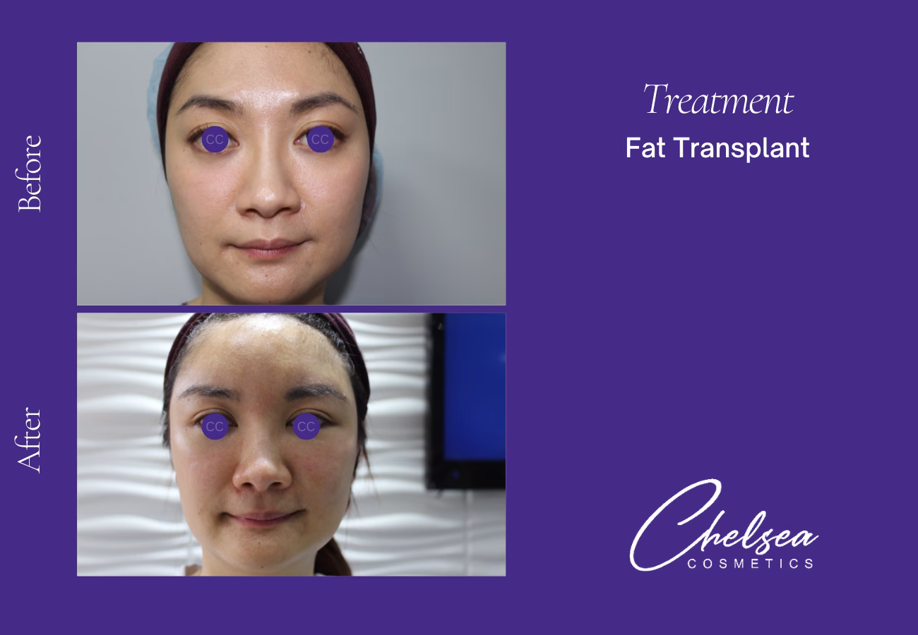 Fat-Transplant-2-2 — Chelsea Cosmetics Melbourne