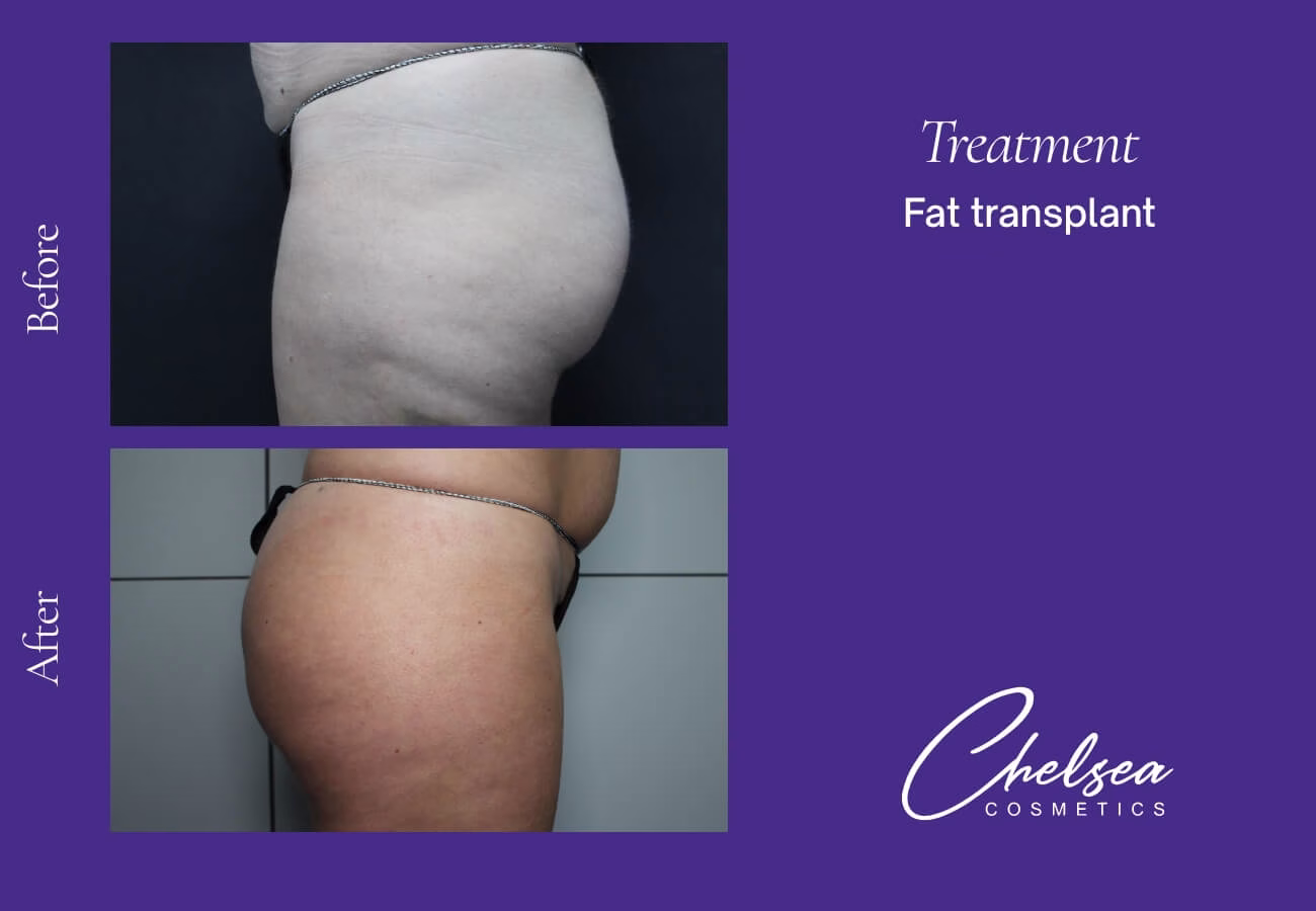 Fat-Transplant-2-2 — Chelsea Cosmetics Melbourne