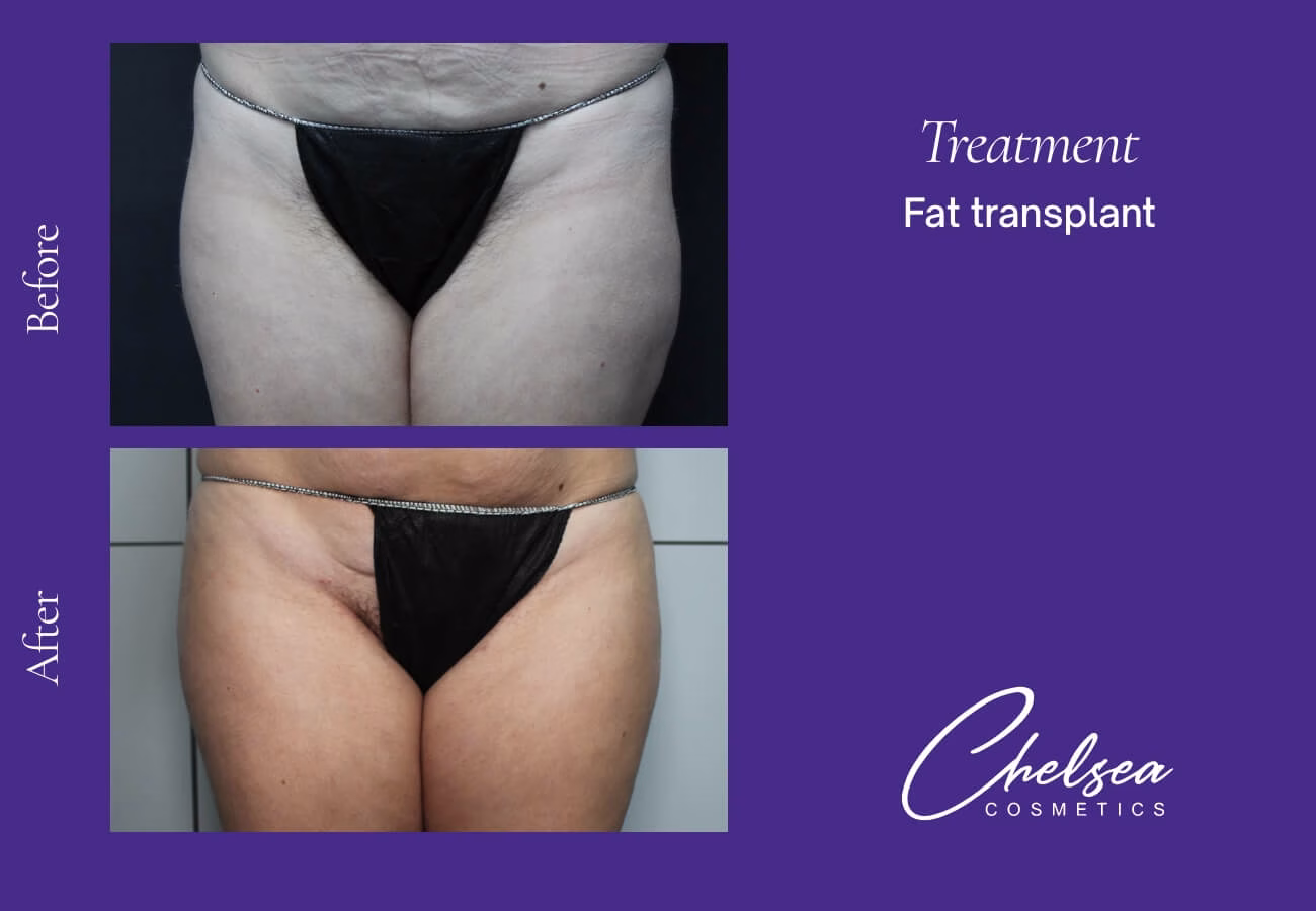 Fat-Transplant-2-3 — Chelsea Cosmetics Melbourne