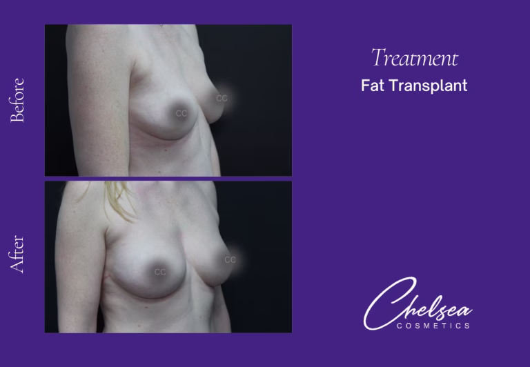 Fat Transfer to Breasts