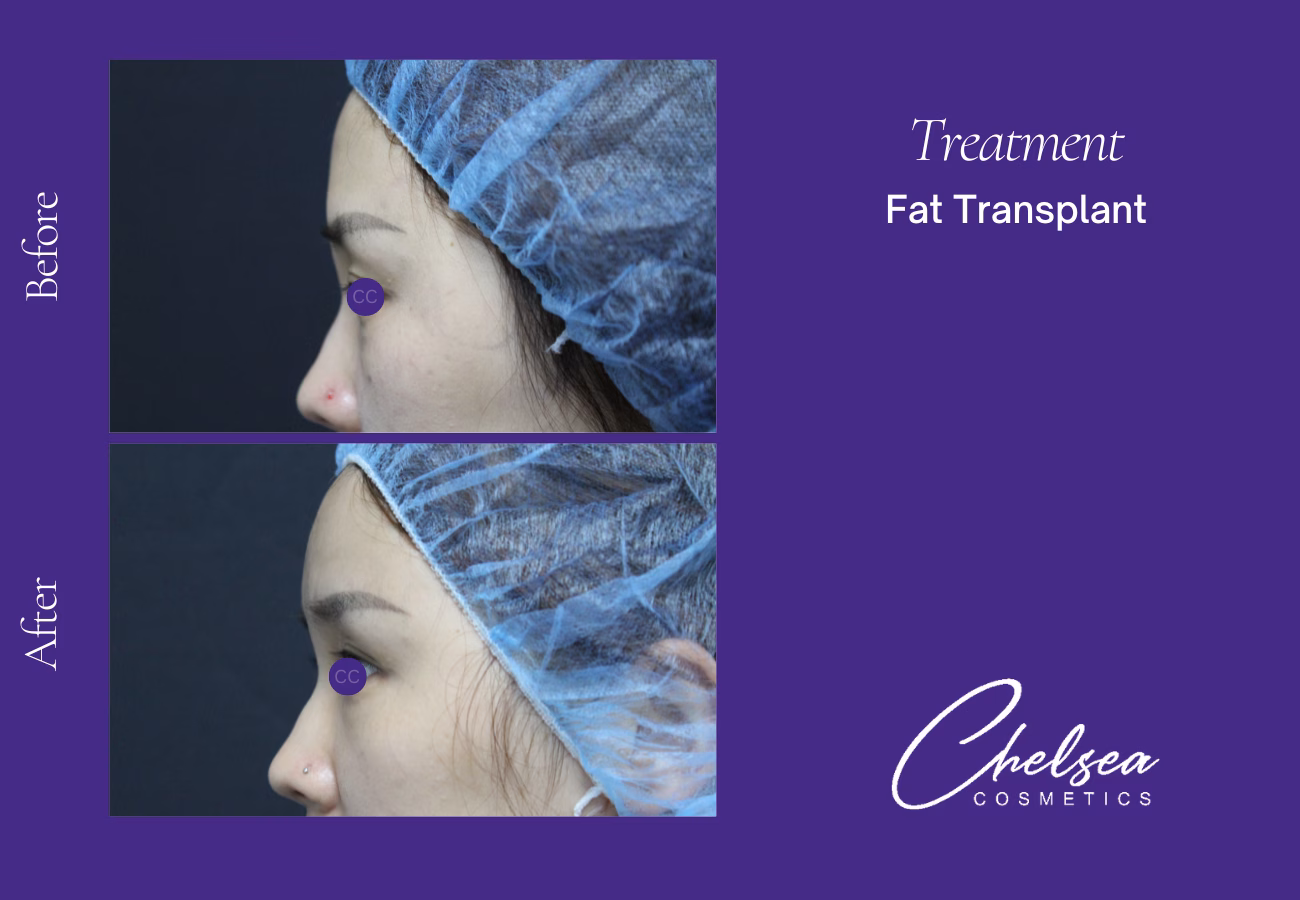 Fat-Transplant-3-2 — Chelsea Cosmetics Melbourne