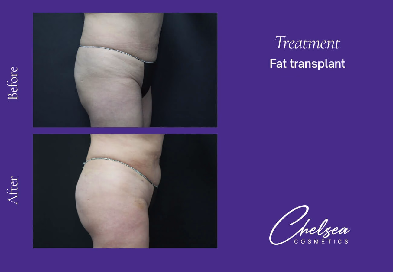 Fat-Transplant-3-2 — Chelsea Cosmetics Melbourne