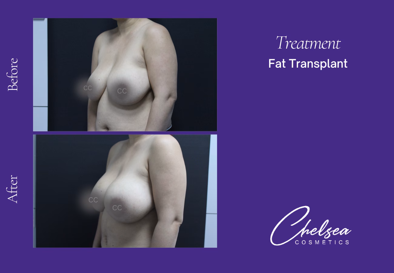 Fat transplant — Chelsea Cosmetics Melbourne