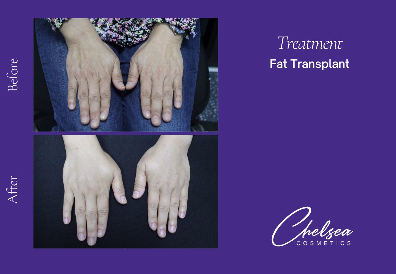 Fat-Transplant-4-2 — Chelsea Cosmetics Melbourne