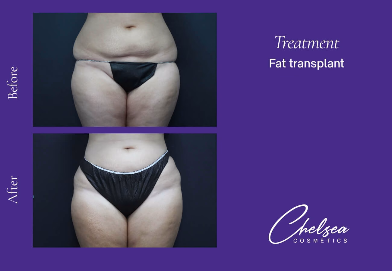 Fat-Transplant-4-2 — Chelsea Cosmetics Melbourne