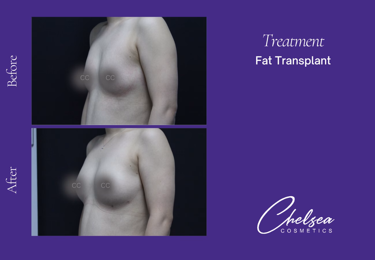 Fat transplant 4 — Chelsea Cosmetics Melbourne