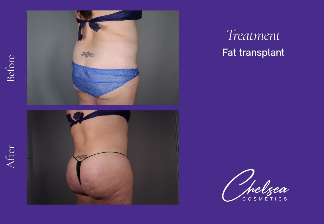 Fat-Transplant-5-1 — Chelsea Cosmetics Melbourne