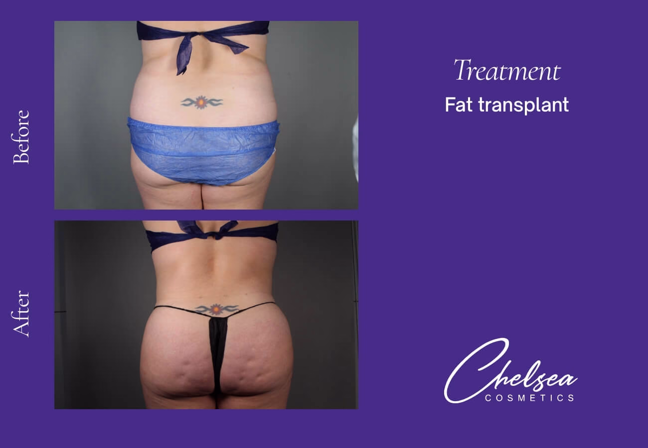 Fat-Transplant-5-2 — Chelsea Cosmetics Melbourne