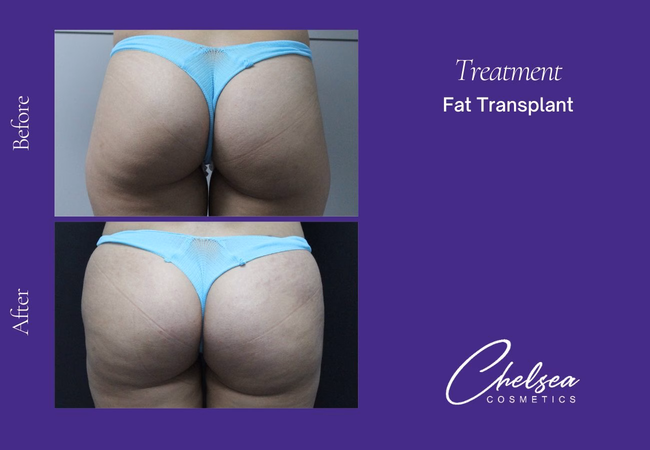 Fat-Transplant-5-2.png — Chelsea Cosmetics Melbourne