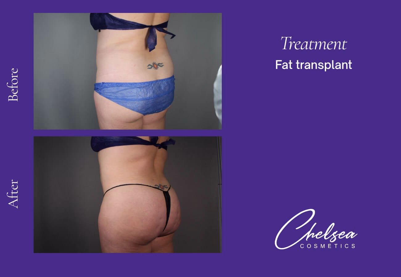 Fat-Transplant-5-3 — Chelsea Cosmetics Melbourne