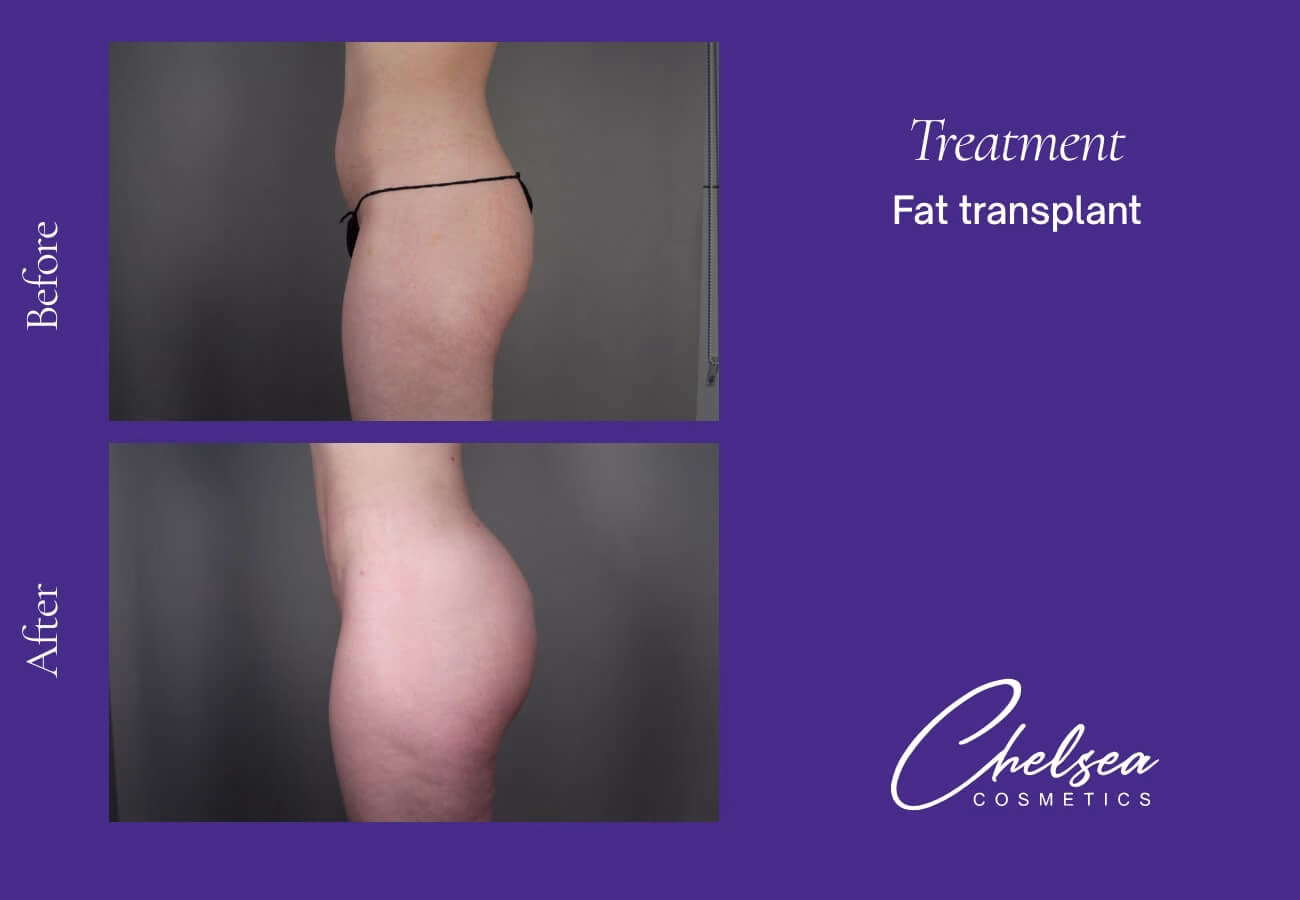 Fat-Transplant-6-2 — Chelsea Cosmetics Melbourne